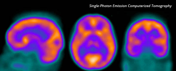 Single-Photon Emission Computerized Tomography